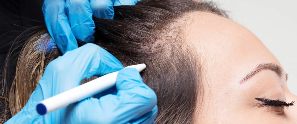 Female Hair Transplant