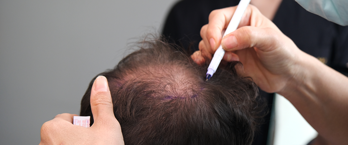 Painless Hair Transplant